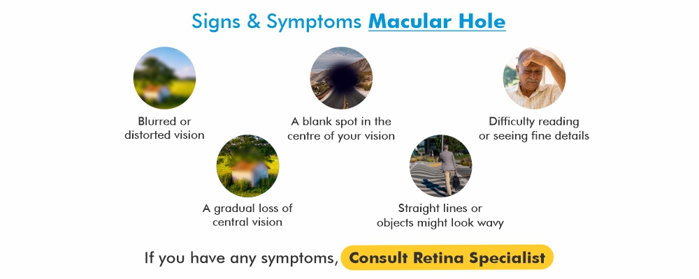 Retinal holes - All About Vision