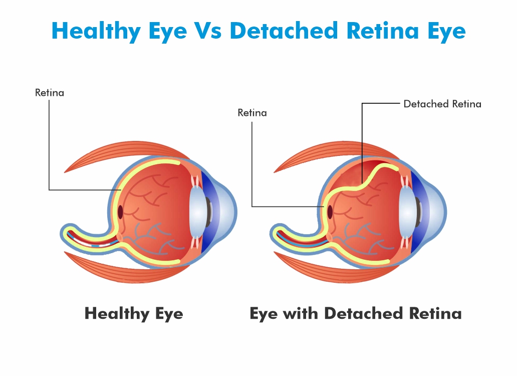 What Causes Retinal Detachment?