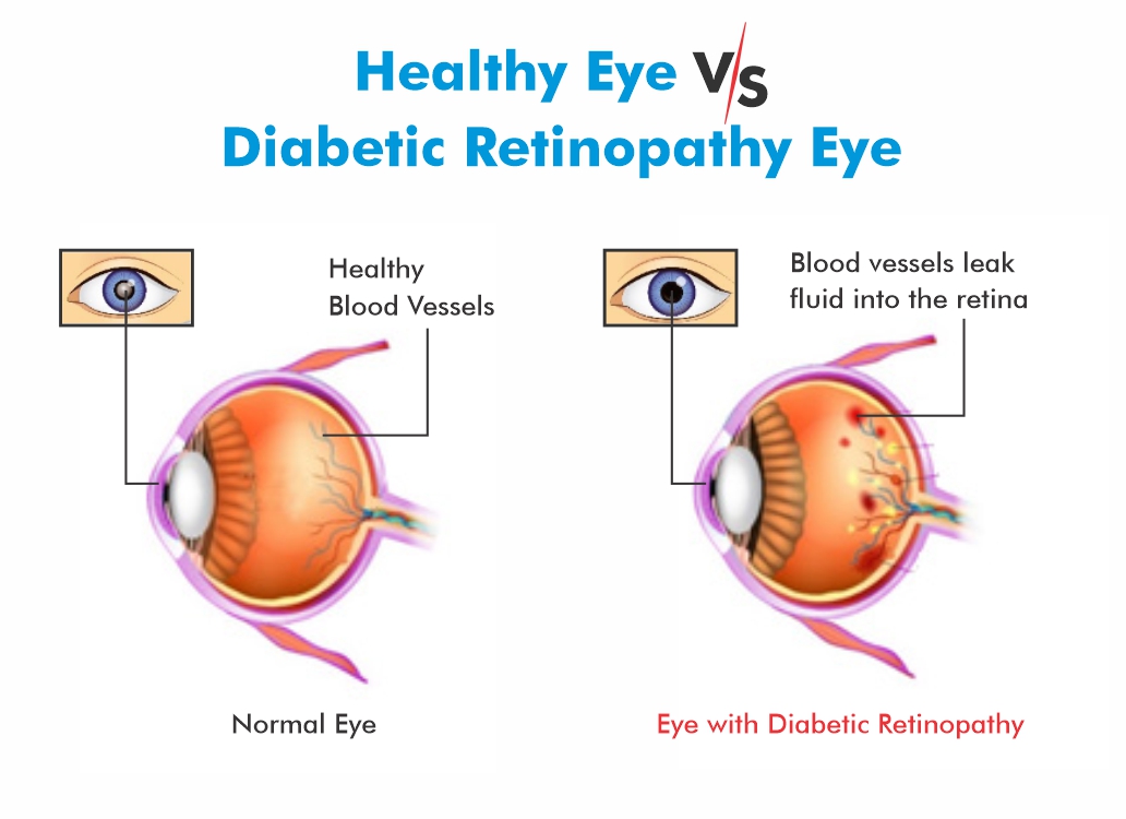 What Is Diabetic Retinopathy Expert s Answers To Queries what-is-diabetic-retinopathy-expert-s-answers-to-queries