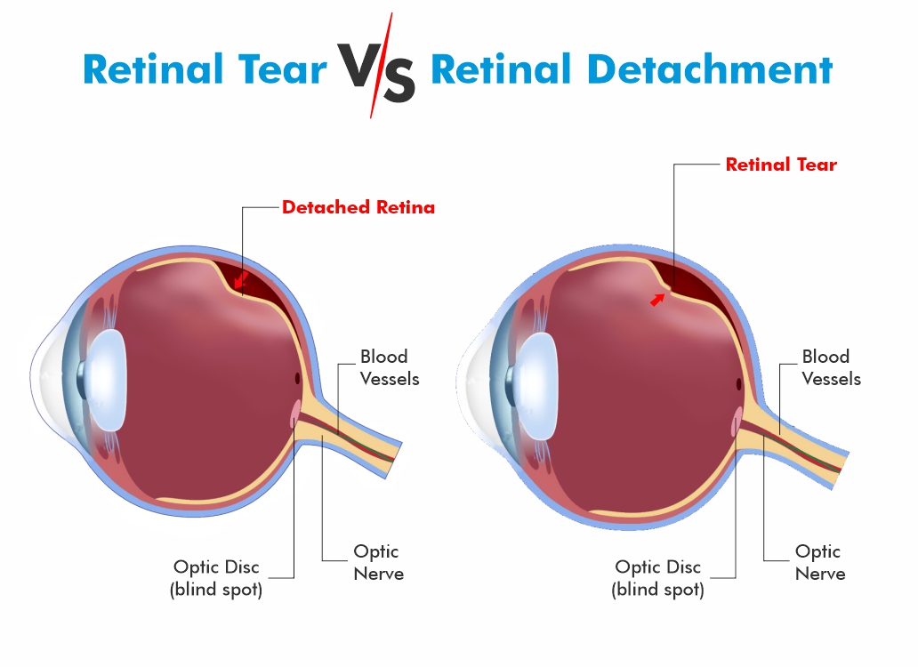 Retinal Tear vs Retinal Detachment Find The Difference
